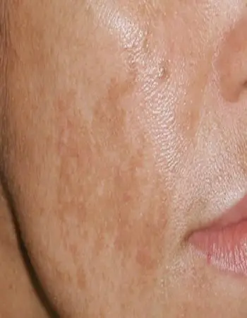 pelle con macchie post peeling chimico